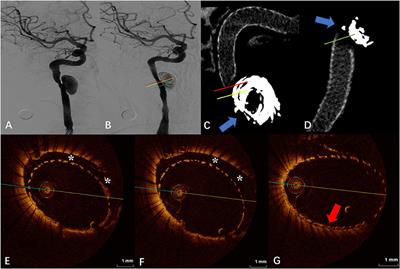 Evaluation of the apposition in unruptured aneurysms treated with flow diverters by optical coherence tomography: Preliminary clinical experience